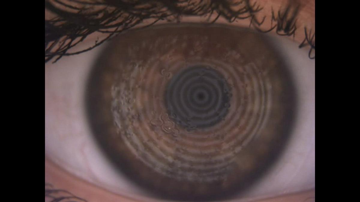 'Video thumbnail for Debris on a contact lens'