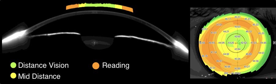 The picture shows a power profile from an bifocal progressive lens design as an alternative for progressive lenses