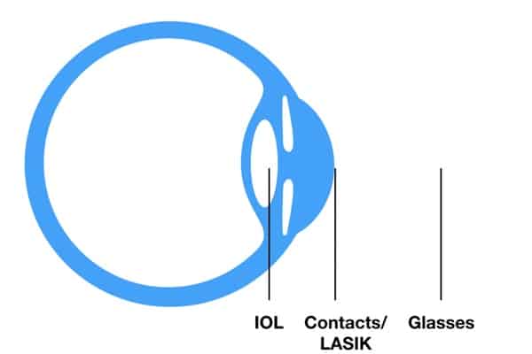 On this picture is an eye and the distances are shown where the different alternatives for progressive lenses will be placed.