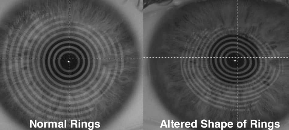 The picture shows the difference between the reflections on an normal eye and an eye with keratoconus