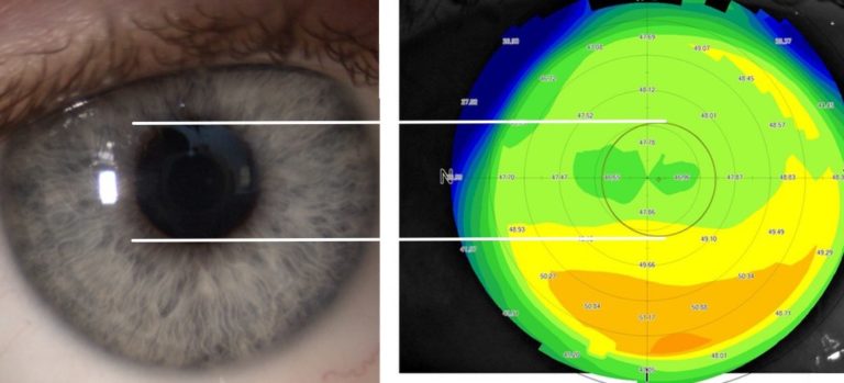 How Do Opticians Test For Astigmatism 
