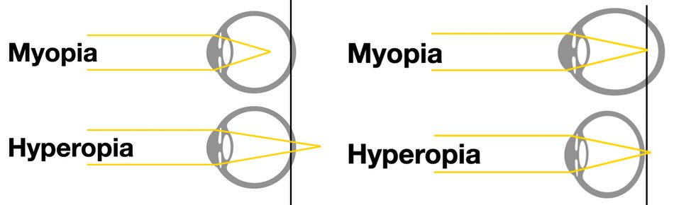 Nearsighted or Farsighted? 1 Simple Tip To Find It Out