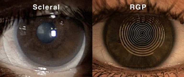 Scleral Lenses Vs Rgp Lenses When To Choose Which