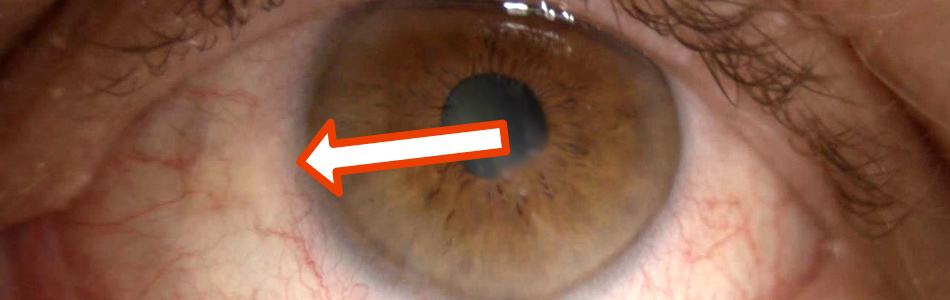 What Do Yellow Spots In Your Eyes Mean